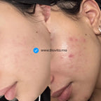 Routine Visage - AcnéClear