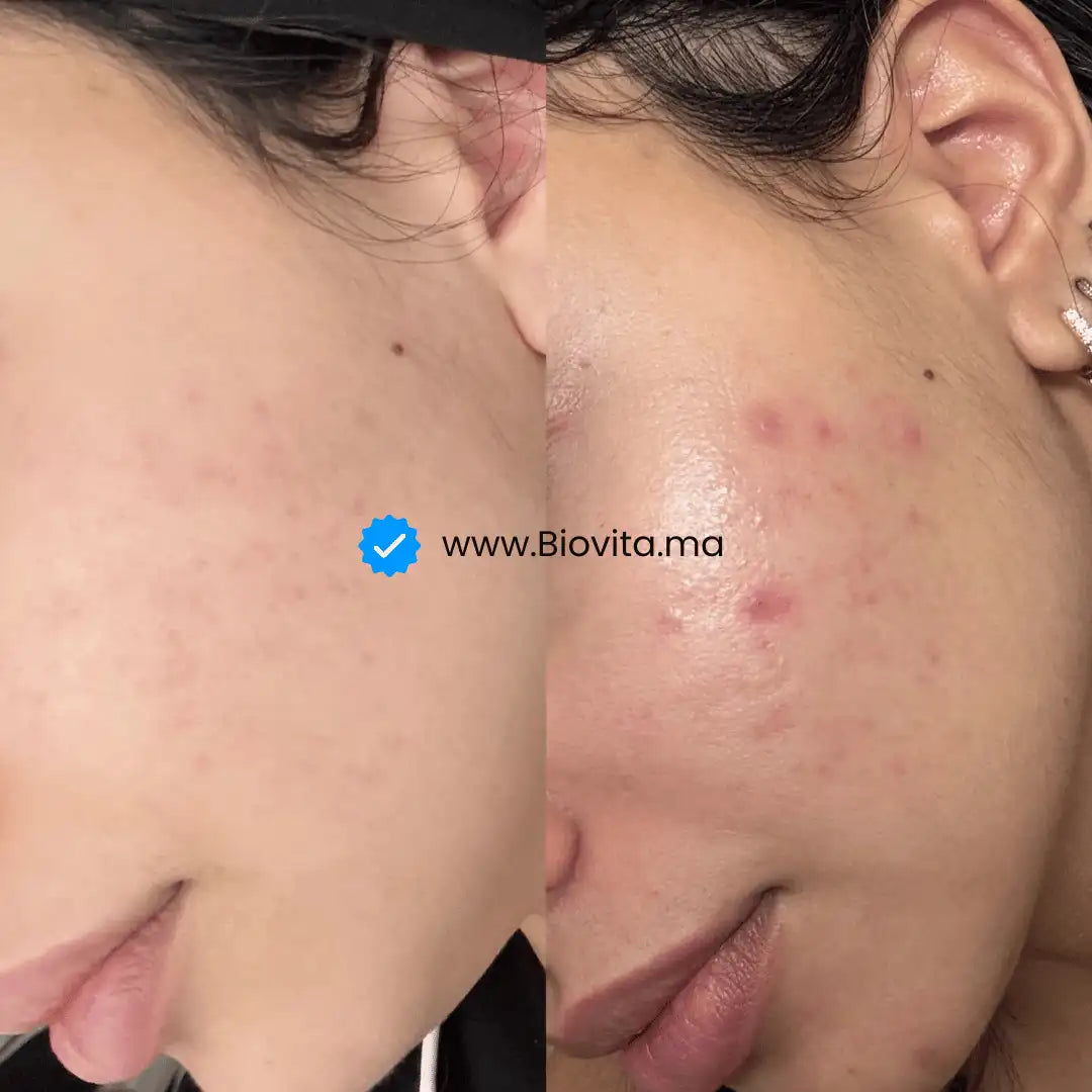 Routine Visage - AcnéClear