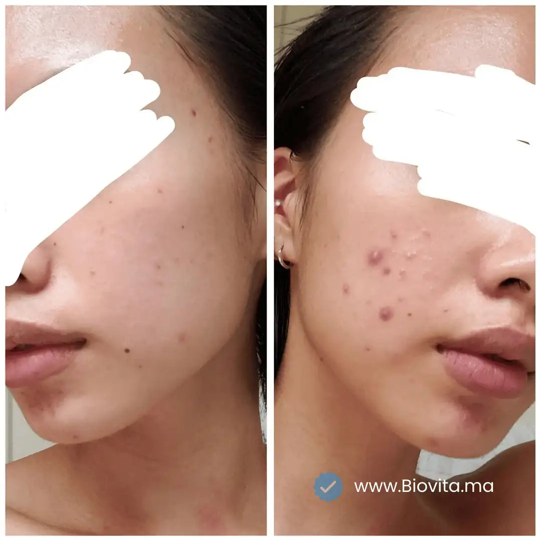 Sérum AcnéClear - Visage | 30ml