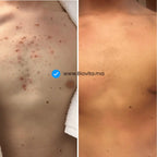 Spray AcnéClear - CORPS | 100ml